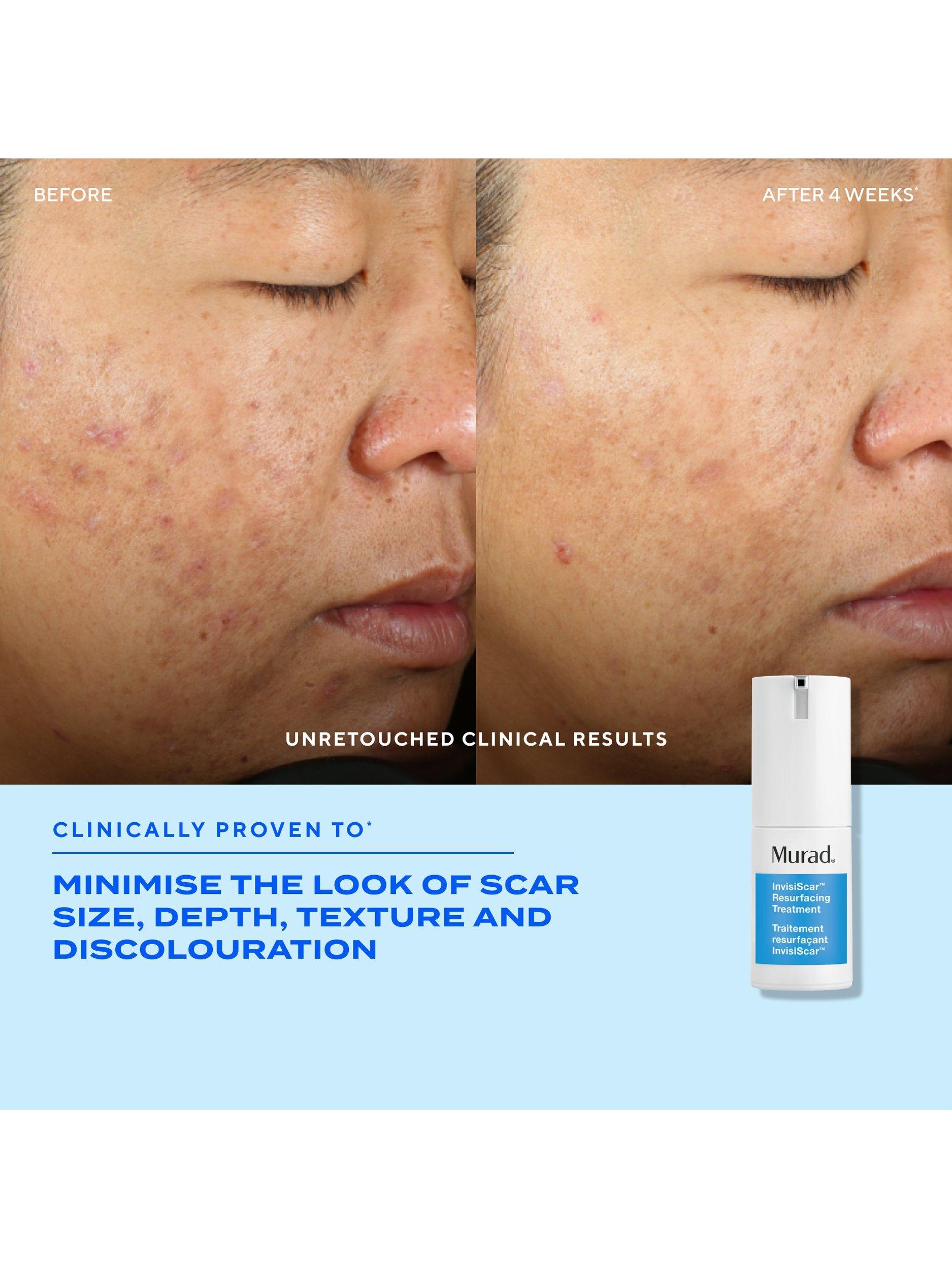 Murad InvisiScar resurfacing treatment 15ml (British brand)