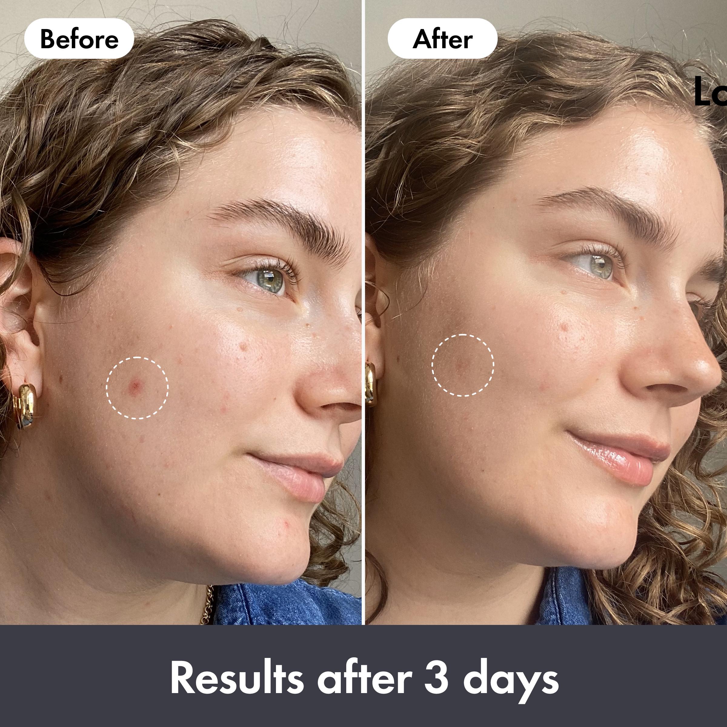 Hero rescue balm post-blemish 15ml - British product