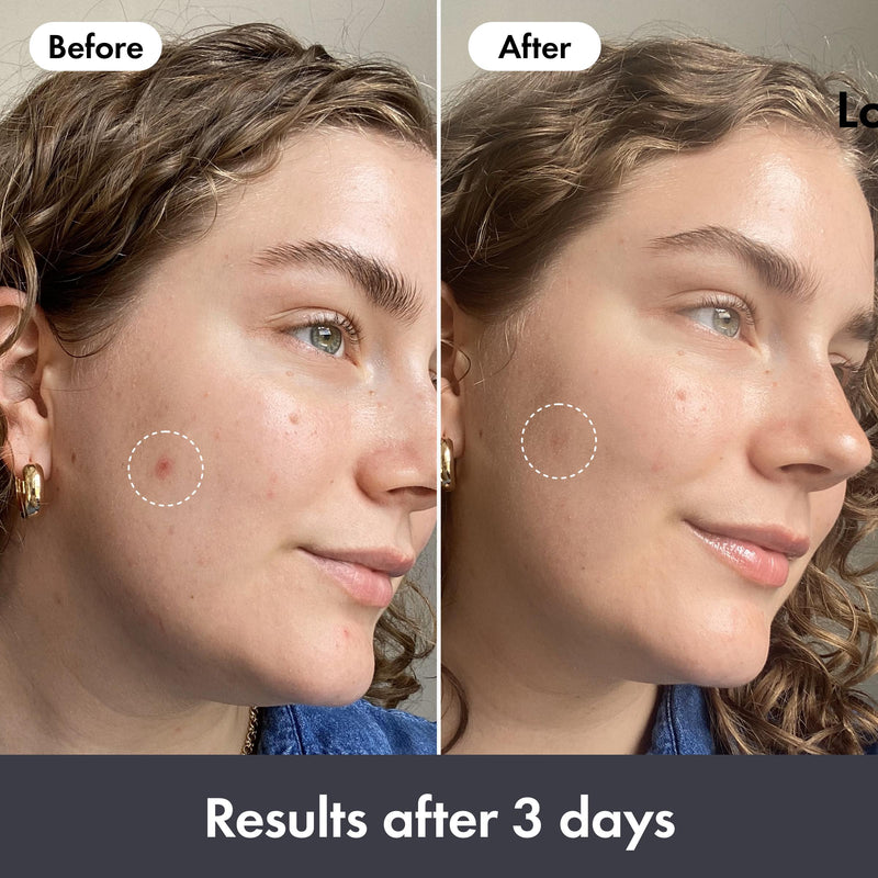 Hero rescue balm post-blemish 15ml - British product