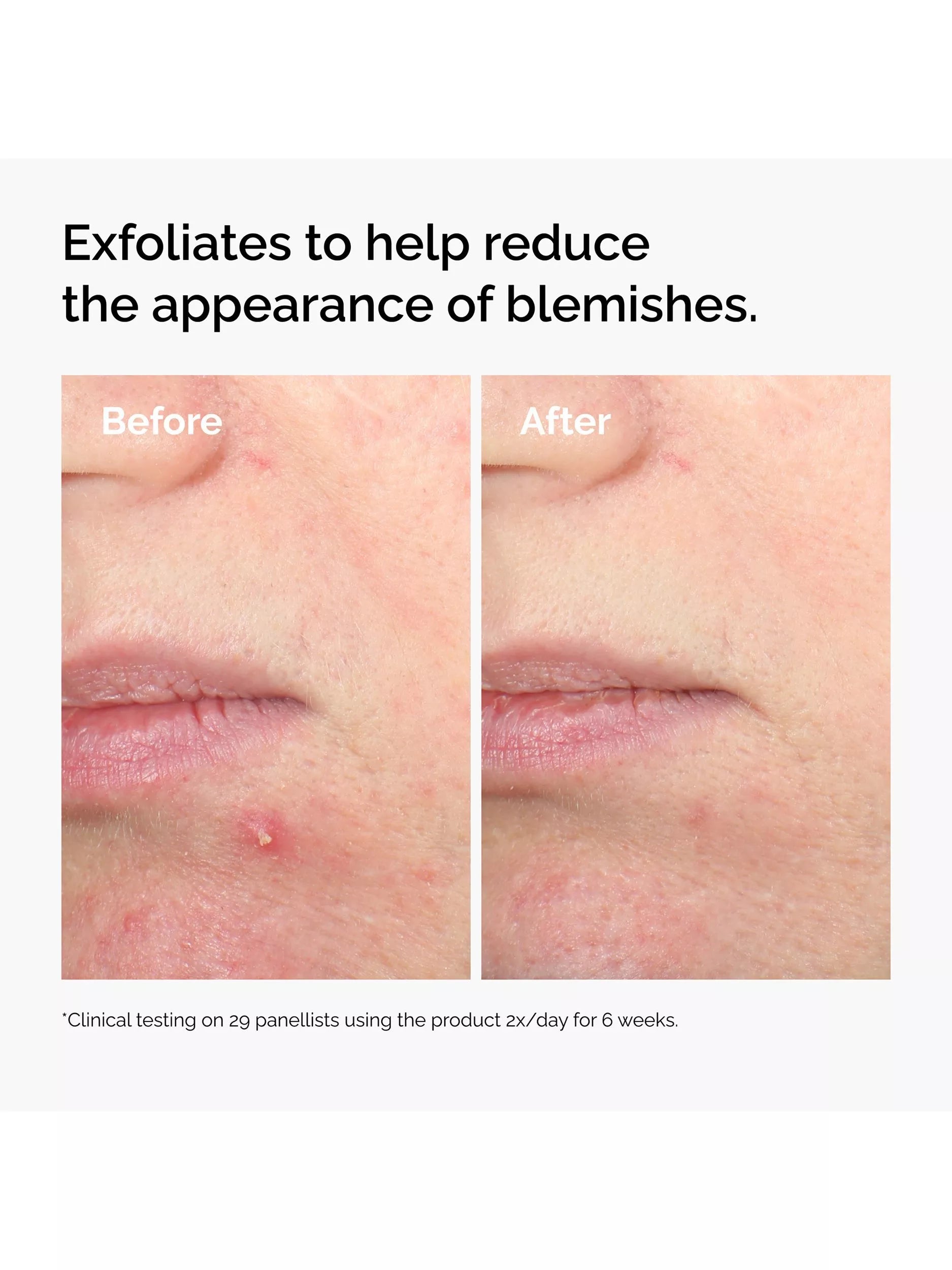 The Ordinary salicylic acid exfoliating serum 30ml, UK version