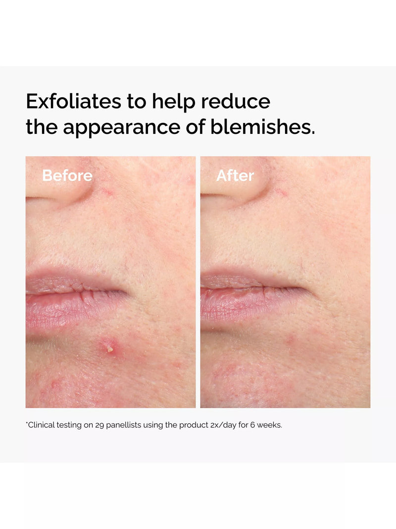 The Ordinary salicylic acid exfoliating serum 30ml, UK version