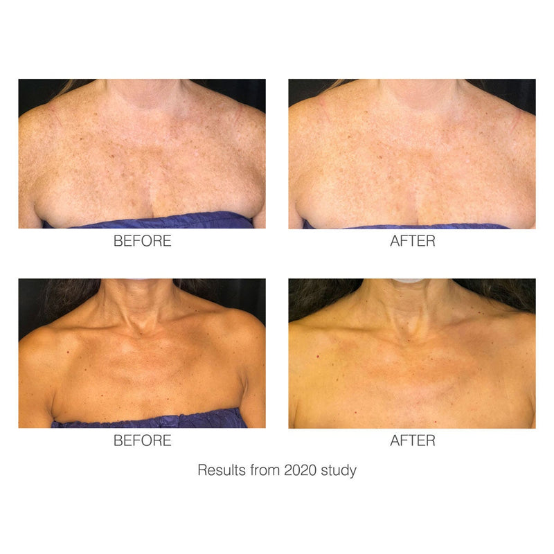 Rio decoLITE LED treatment mask, imported from the UK
