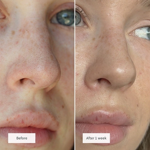 Vue nose patches 8pcs (British brand)