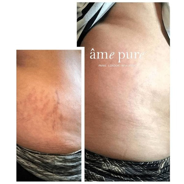 âme pure Body Basic | Stretch Marks 0.75mm GOODS Superdrug   