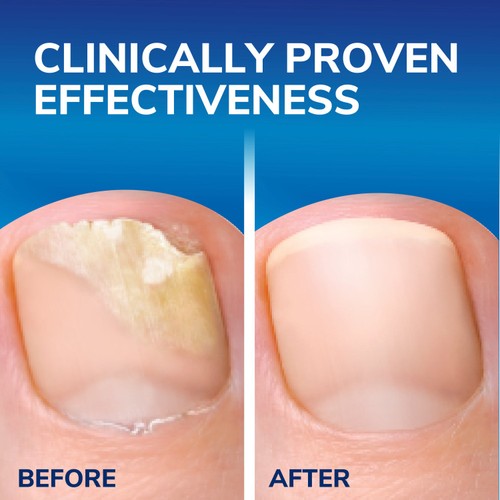 Scholl Fungal Nail 2 in 1 Treat & Shield 3.8mL - British product