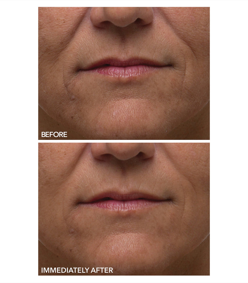 Dr Dennis Gross gentle peel sensitive skin 5 treatments - British product