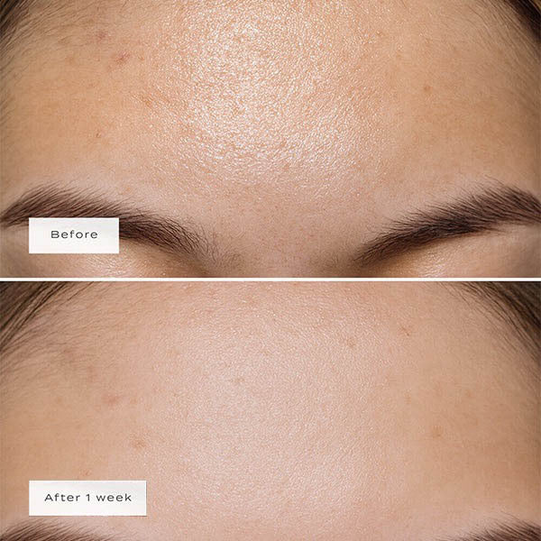 Vue forehead patches 5pcs (British brand)