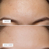Vue forehead patches 5pcs (British brand)