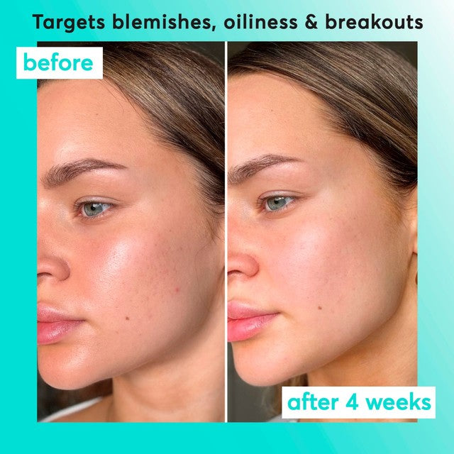 Super Facialist Clear Skin Breakout Buster Serum 30ml (British brand)