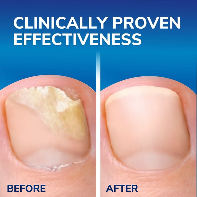Scholl Fungal Nail 2 in 1 Treat & Shield 3.8mL - British product