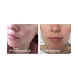 Science of Skin Rescue facial scar treatment 30ml (British brand)