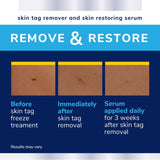 Scholl skin tag remover kit - British product