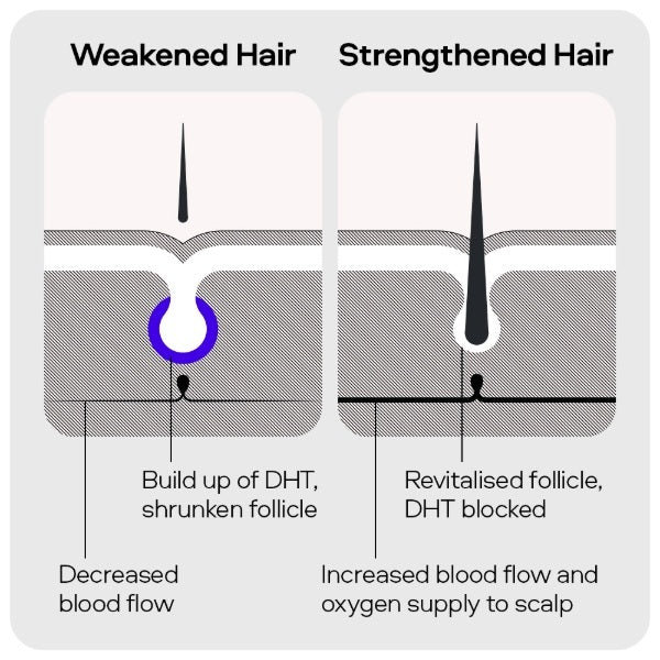 Sons hair regrowth Minoxidil 5% spray 3-month supply, imported from the UK
