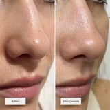 Vue nose patches 8pcs (British brand)