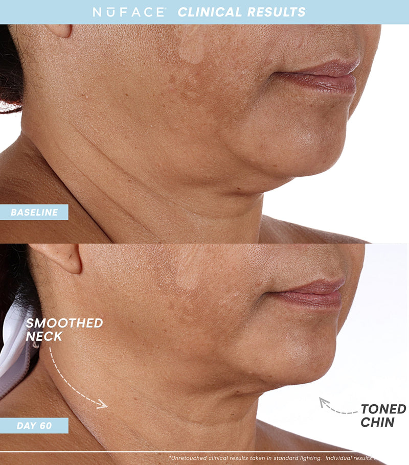 Nuface Trinity+ Starter Kit facial toning device with attachments and serums, imported from the UK
