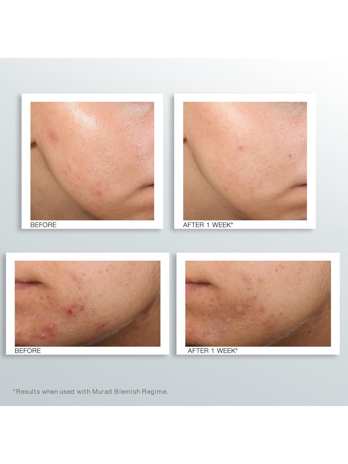 Murad Outsmart Blemish Clarifying Treatment Serum 50ml