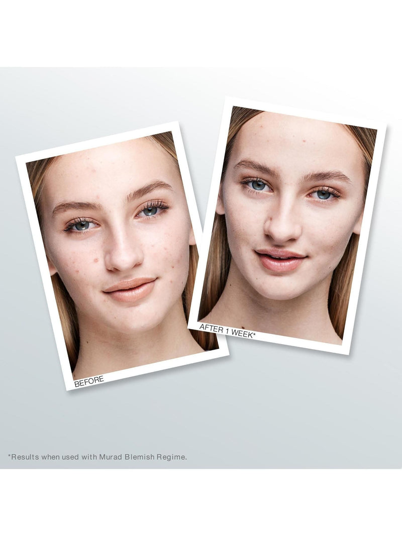 Murad Outsmart Blemish Clarifying Serum 50ml, imported from the UK