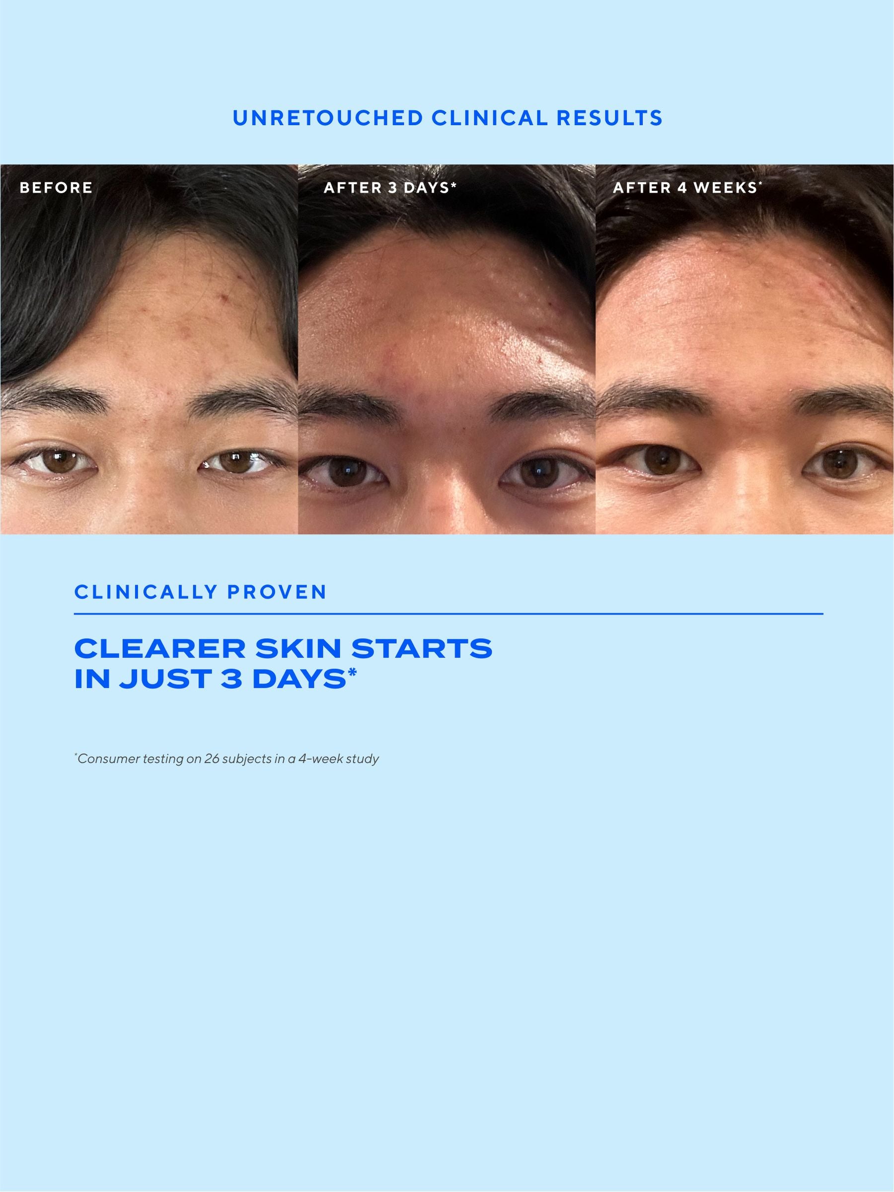 Murad Biome Balancing Clear Prevent Blemish Treatment Serum, imported from the UK