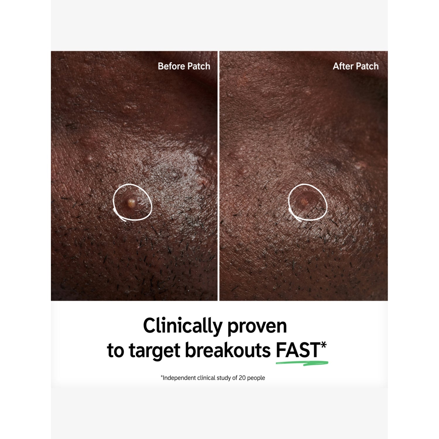 The INKEY List hydrocolloid invisible pimple patches (British brand)
