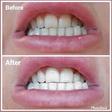 SmileTime ST01 Teeth Stain Remover