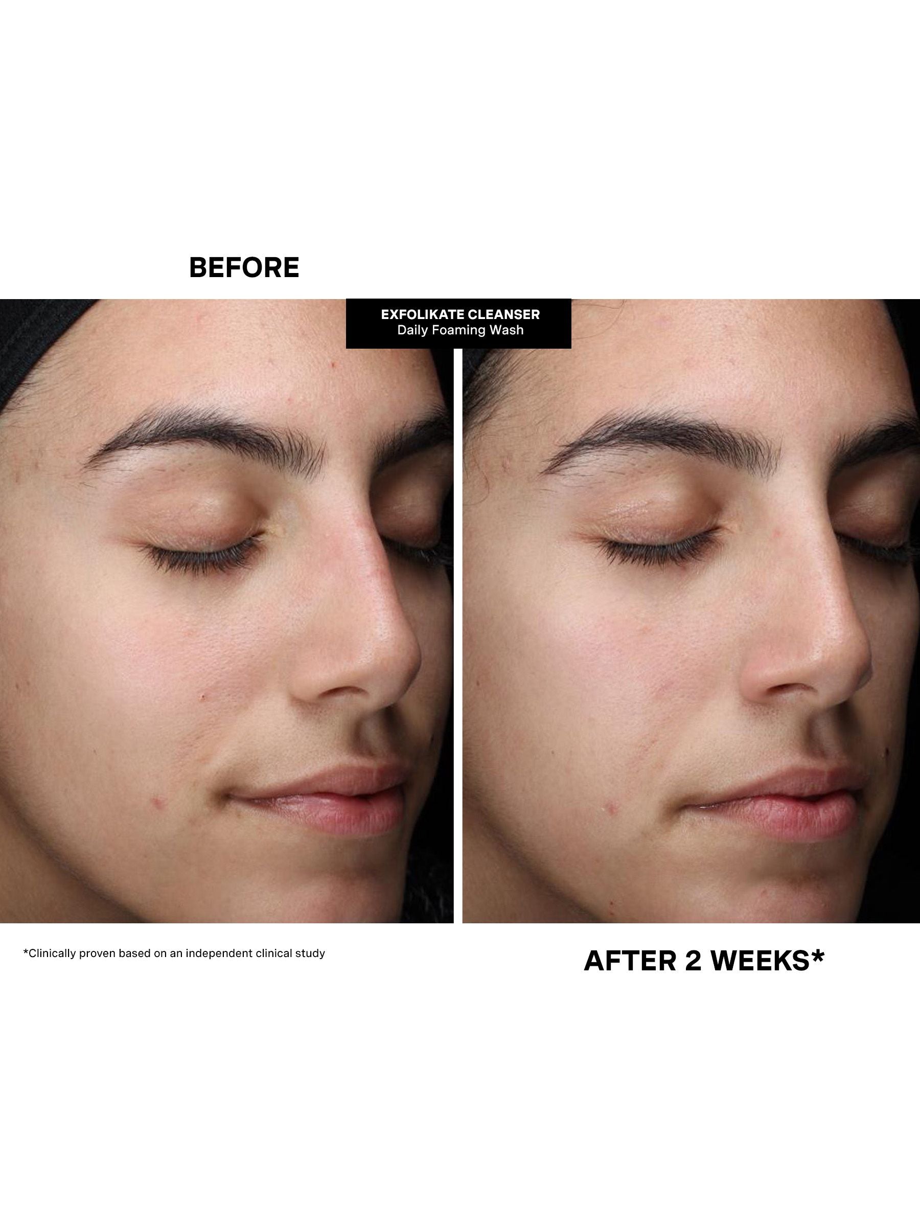 Kate Somerville Pore-fect Skin Edit travel kit - British product