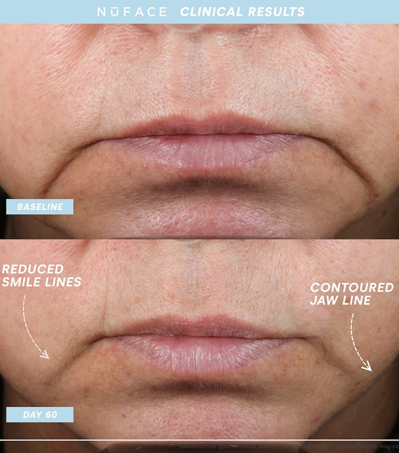 Nuface Trinity+ Starter Kit facial toning device with attachments and serums, imported from the UK