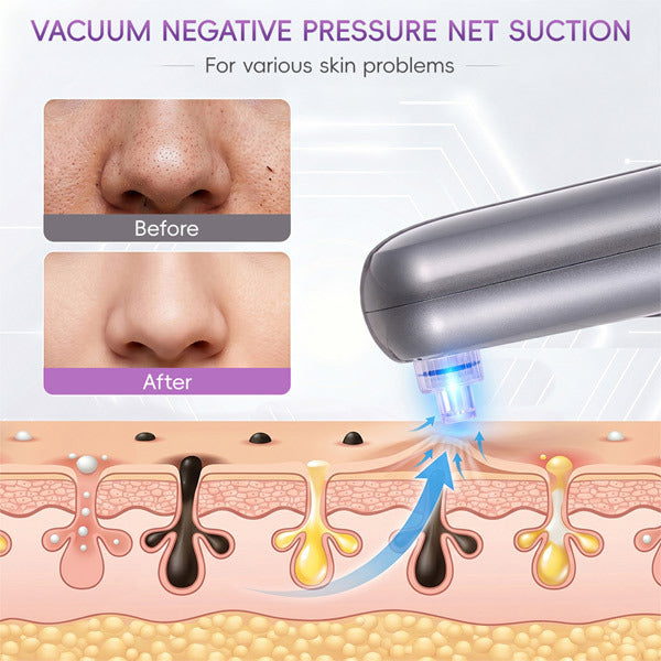 Livingandhome Blackhead Remover 3 Suction Modes, UK version
