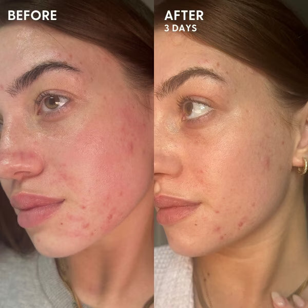 Superdrug scar gel treatment for wounds and acne scars 19g (British brand)