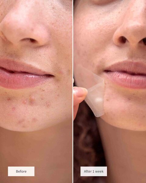 Vue Chin Patches 8 patches imported from the UK