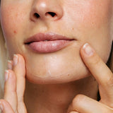 Vue Chin Patches 8 patches imported from the UK