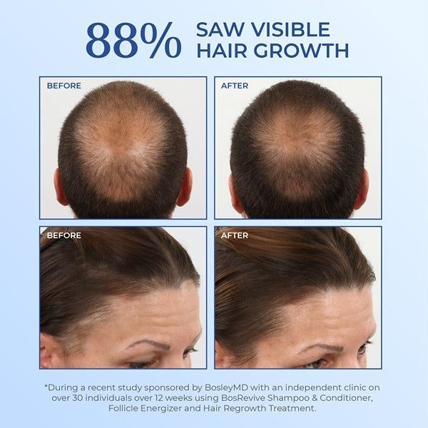 BosleyMD Hair Loss Shampoo Non Colour Treated  300ml - McGrocer