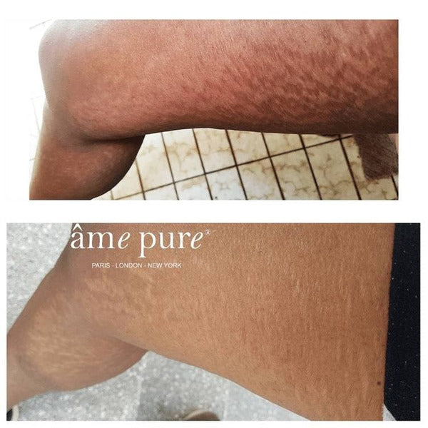 âme pure Body Basic | Stretch Marks 0.75mm