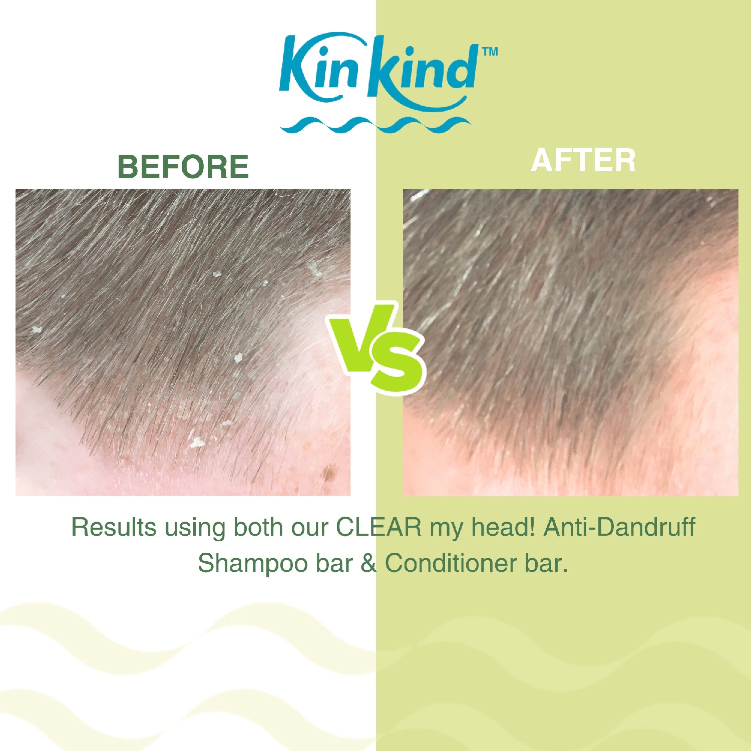 KinKind anti dandruff shampoo bar 50g - British product