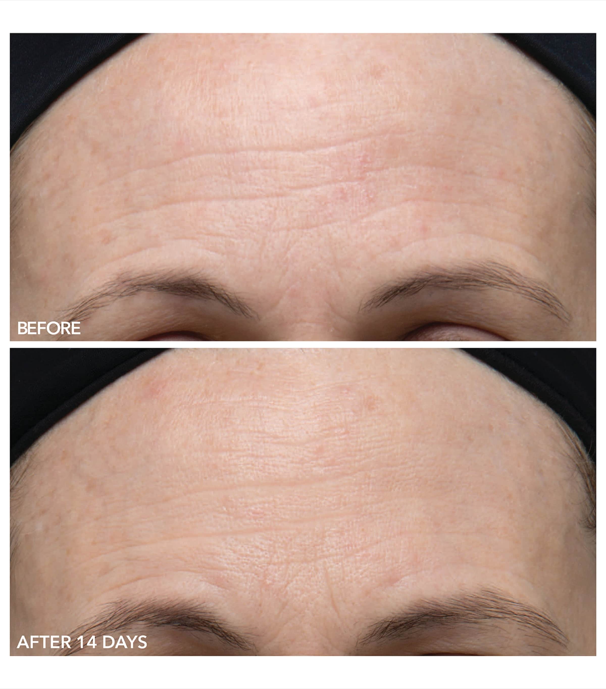 Dr Dennis Gross Alpha Beta Gentle Peel (5 Treatments)
