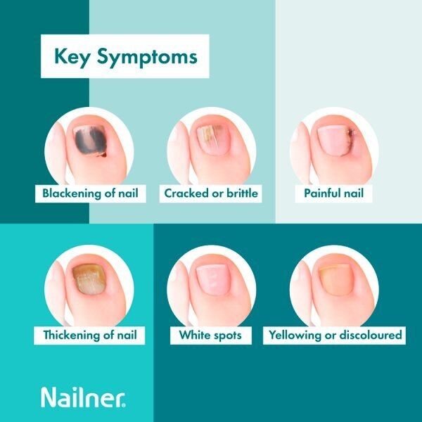 Nailner Ara () Nailner Ara