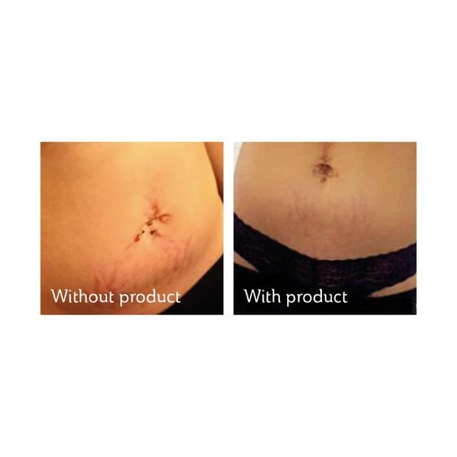 Science of Skin Solution for Stretch Marks   100ml